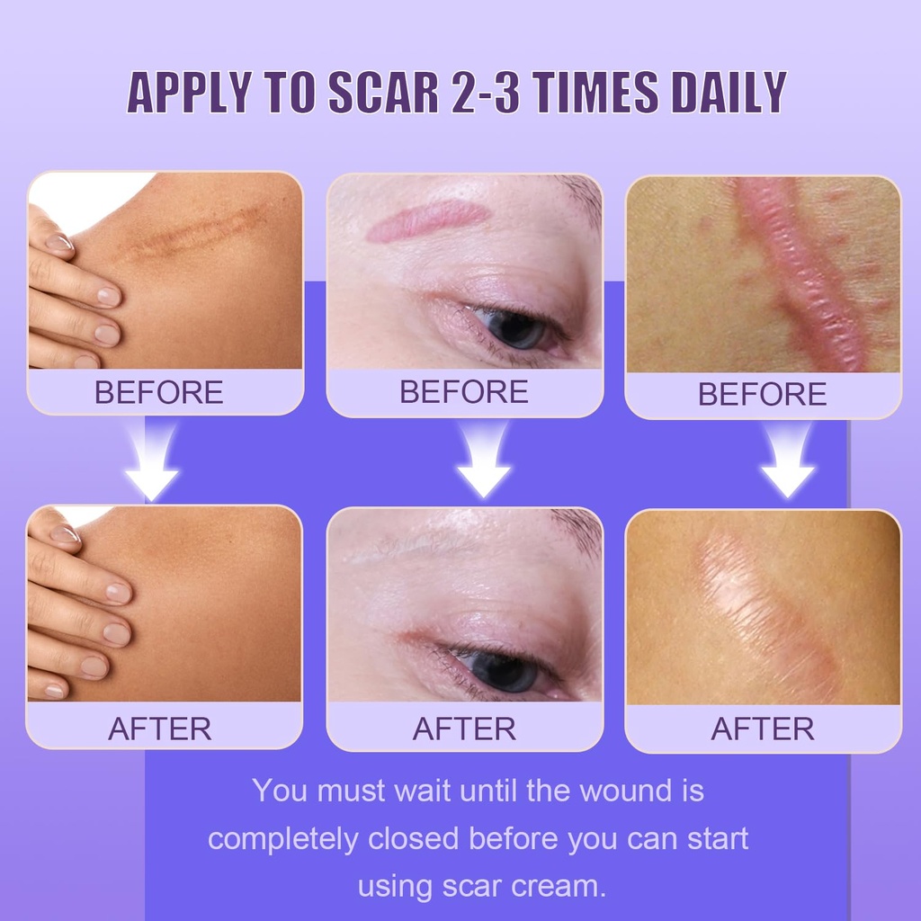 silicone-scar-cream-scar-gel-advanced-sc-6.jpg