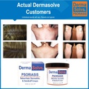 dermasolve-psoriasis-seborrheic-dermatit-5.jpg
