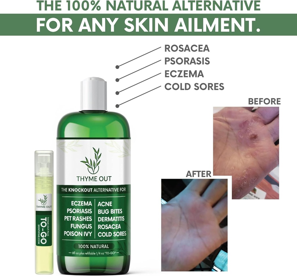 all-natural-eczema-treatment--psoriasis--2.jpg