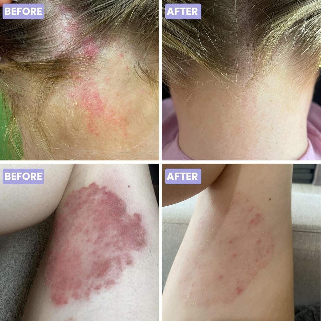 grahams-natural-psoriasis-cream---moistu-6.jpg