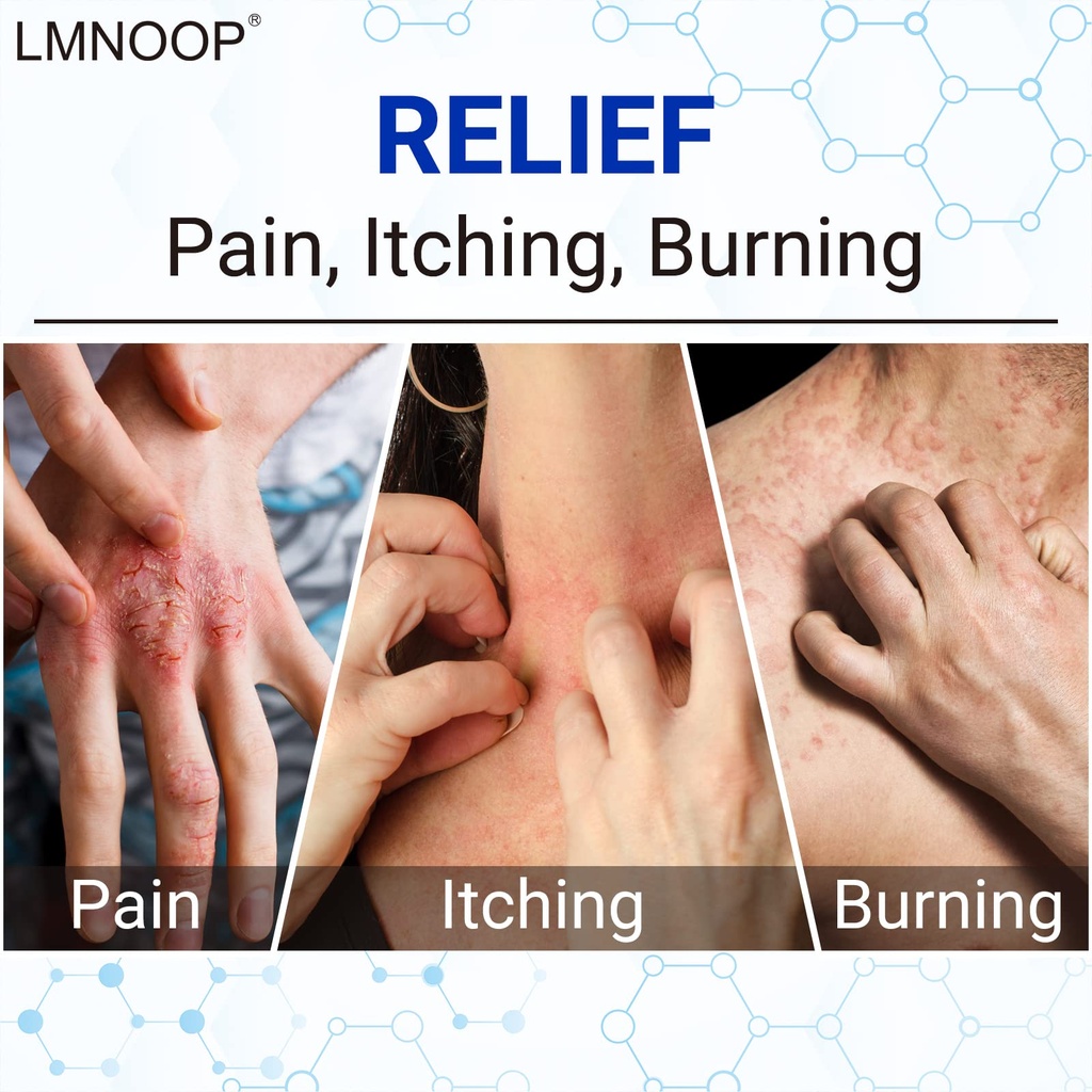 eczema-cream-maximum-strength-treatment--2.jpg